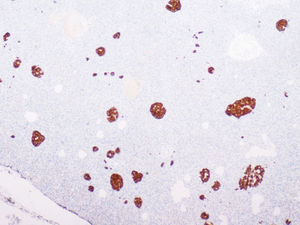 Imagen con tinción inmunohistoquímica que muestra estructuras ducto insulares (tinción con enolasa;×4).