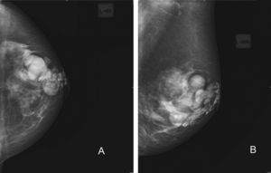 Caso 1. Mamografías de mama izquierda. A) Proyección craneocaudal. B) Proyección oblicua. Se aprecian zonas radiopacas distribuidas de manera dispersa por el tejido mamario que dificultan la identificación de posibles lesiones parenquimatosas.