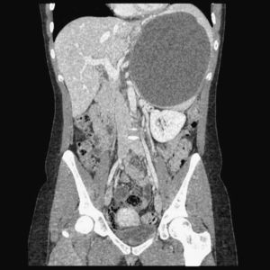 Gran lesión esplénica de 12×14×16cm, quística, sin calcificación ni septos.