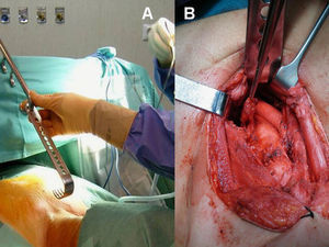 A) Imagen de posicionamiento del paciente con el retractor esternal. B) Imagen de la cirugía donde se observa la disección de las adenopatías del grupo 4l, así como la arteria innominada.