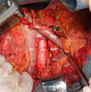 Detalle linfadenectomía interaortocava i vena yeyunal. AH, arteria hepática. VRI, vena renal izquierda. VCI, vena cava inferior. Ao, aorta. P, sección cuello pancreático. VMS, vena mesentérica superior. AMS, arteria mesentérica superior. VYy, vena yeyunal.