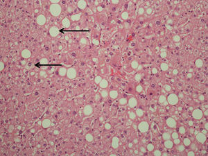 Hematoxilina-eosina (20×): preparación histológica de tejido hepático con microscopía óptica. Se observan diferentes zonas del parénquima hepático con esteatosis y balonamiento hepatocelular (flechas).