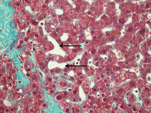 Tricrómico de Masson (40×): preparación histológica de tejido hepático con microscopía óptica en la que se aprecian áreas de intensa dilatación sinusoidal (flechas).