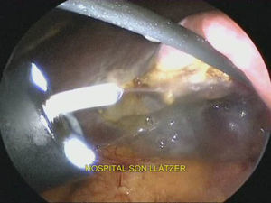 Visión laparoscópica del endoscopio flexible con salida de la cánula por su canal de trabajo y emisión de fibrina en el lecho de colecistectomía.