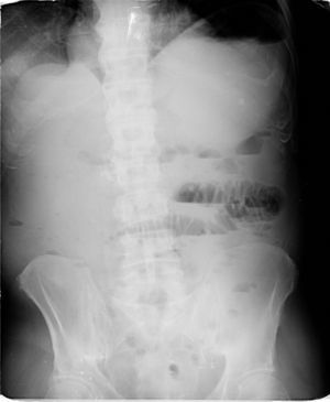 Radiografía de abdomen. Asas de intestino delgado dilatadas, indicativo de cuadro de obstrucción intestinal.
