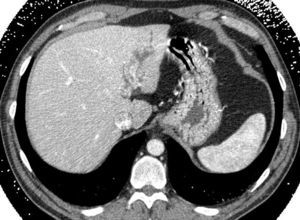 TC abdominal que evidencia la presencia de una lesión de aspecto sólido endoluminal en la vía biliar principal izquierda.