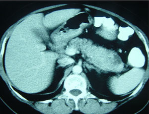 TAC abdominal donde se observa el tumor pancreático de 7cm entre el cuerpo y la cola del páncreas.