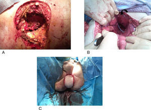 A) Defecto perineal tras RAP, B y C) Rotación del colgajo a la pelvis (flecha) y periné.