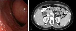 A) Visión endoscópica del QDD. B) TC abdominal: Se observa lesión quística en la pared del duodeno (flecha).