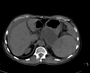 Tomografía computarizada abdominal sin contraste en la que se muestran imágenes hipodensas indicativas de rotura esplénica contenida y compresión del seudoquiste pancreático.