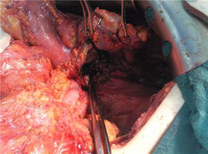 Resección parcial del seudoquiste pancreático y preparación de la cistogastrostomía.