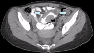 Imagen de la tomografía computarizada con contraste intravenoso. Se aprecia una masa de 16×7cm de diámetro en yeyuno distal-íleon proximal.