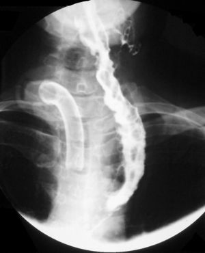 Tránsito de contraste de una ileocoloplastia supercharged.