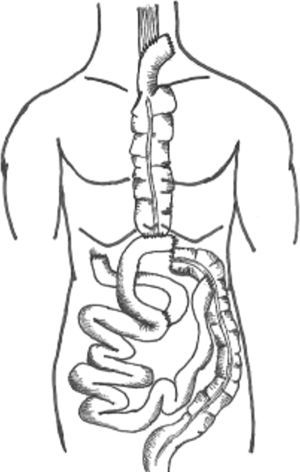 Esquema de la ileocoloplastia supercharged.