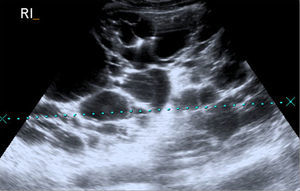 Ecografía abdominal que muestra los riñones aumentados de tamaño con múltiples quistes.