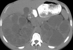 Vesícula biliar de características normales en íntimo contacto con los quistes del polo renal superior derecho.