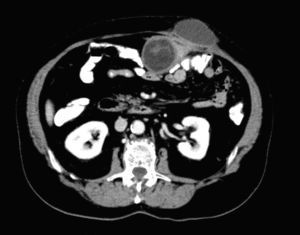 Tomografía computarizada abdominal: 2 lesiones quística (intraperitoneal y subcutánea).
