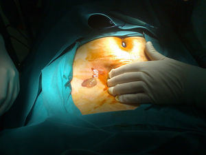 Salida de pus y escólices al comprimir la lesión subcutánea.