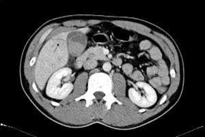 TAC abdominal: herida incisa con hematoma en la pared abdominal, laceración hepática (flecha), perforación vesicular con coágulo en su interior y líquido libre perivesicular.