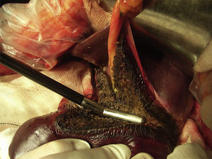 Imagen de la transección con Coolinside® durante el ensayo clínico. La foto corresponde con una bisegmentectomía 2, 3 realizada en el tercer paciente de la serie.