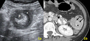 a) Ecografía abdominal con imagen sugestiva de asa intestinal invaginada, consistente en una capa hipoecoica (asterisco) y otra capa interior hiperecogénica con una lesión hipoecoica sugestiva de tumor sólido polipoideo (P). b) TCMD tras contraste oral e i.v. con el característico target sign (flechas) en un segmento yeyunal del vacío-hipocondrio izquierdos; asocia lesión central sólida polipoidea levemente captante de contraste, de 2cm de diámetro (asterisco).