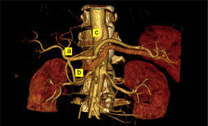 TAC abdominal con abstracción vascular arterial del tronco celíaco y arteria hepática. B) Arteria gastroduodenal. C) Arteria gastroepiplóica derecha ascendente hacia la plastia gástrica intratorácica.