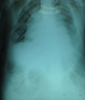 Radiografía toraco-abdominal de pie: imagen cálcica con superposición de asas intestinales en hipocondrio derecho.
