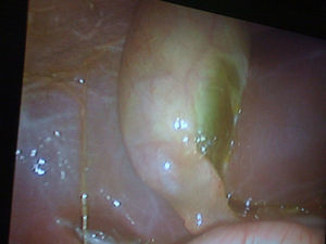 Imagen laparoscópica donde se evidencia placa necrótica vesicular y coleperitoneo.