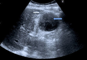 Ecografía abdominal. Flecha blanca: signo de doble pared. Flecha azul: coágulos en el interior de la vesícula.
