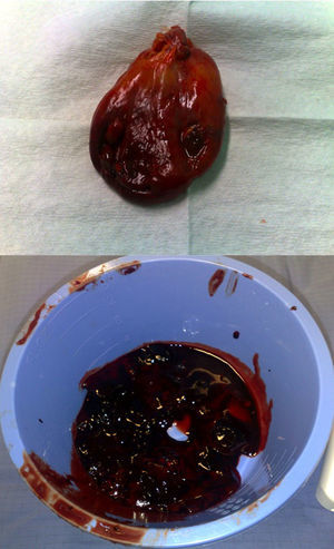A: vesícula con paredes engrosadas y hemorrágicas. B: coágulos intravesiculares.
