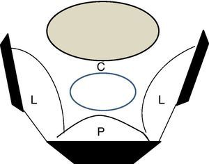 Subsitios de recurrencia pélvica de acuerdo al grupo de Leeds10. C: central; L: lateral; P: posterior).