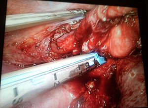 Por vía toracoscópica y tras disección del quiste, se coloca una endograpadora en la zona de implantación del quiste.