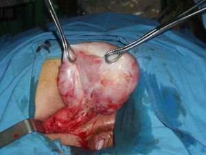 Exéresis quirúrgica; masa de coloración blanco-parduzca y aspecto encapsulado que desplaza el esfínter anal (E).