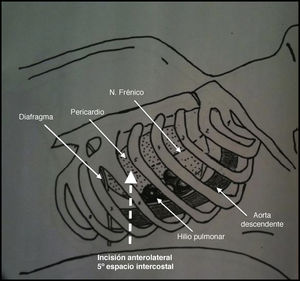 Relación de las diferentes estructuras en la incisión antero-lateral en la toracotomía de urgencia.