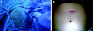Gastrectomía tubular efectuada mediante técnica endoscópica de acceso único. a) Localización del dispositivo. b) Imagen de la cicatriz postoperatoria.