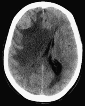 Imagen de tomografía computarizada con contraste. Se aprecian dos lesiones cerebrales, a nivel parietal y talámico derecho con edema perilesional, efecto masa y desviación contralateral de la línea media.