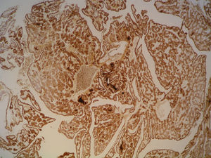 Imagen microscópica de una metástasis cerebral (10x). Las células tumorales muestran positividad frente a tiroglobulina. Se observa una arquitectura papilar y la formación de folículos que son muy sugestivos de metástasis de carcinoma papilar de tiroides.