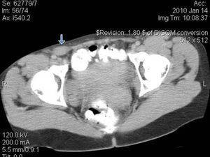 Tomografía axial computarizada que evidencia la presencia de tejido de partes blandas en el conducto inguinal derecho (flecha).