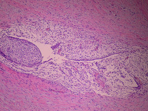 Imagen de microscopia óptica en donde se observa tejido fibroconectivo con presencia de endometrio constituido por estroma citógeno edematoso y revestimiento glandular superficial aplanado (hematoxilina-eosina, 200x).