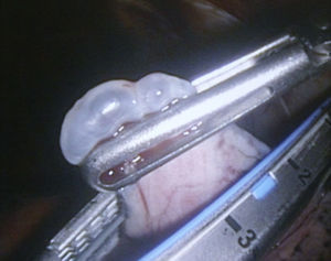 Resección endoscópica de bullas. ENDOGIA® 45-3,5mm.