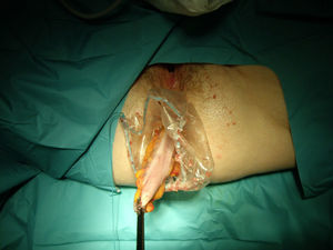 Extracción transanal de la pieza en el interior de una bolsa de plástico para extracción de vísceras usando una pinza de agarre laparoscópica.