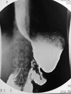Estudio esófago-gastro-duodenal baritado. Se observa la estenosis de la anastomosis gastroyeyunal tipo Billroth II.