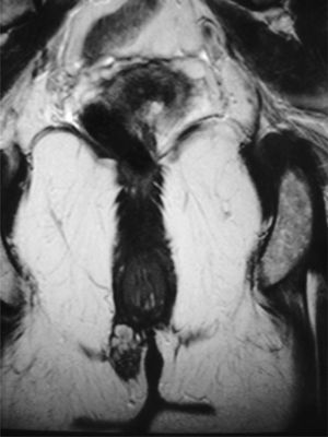 Imagen de RM pelviana en la que se aprecia colección polilobulada de unos 2,4×1,6cm de diámetro, situada a nivel del margen anal externo derecho.