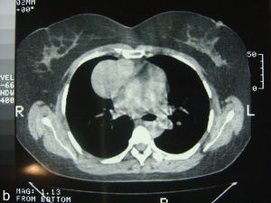 a. Rx de tórax postero-anterior: evidencia de masa paramediastinica derecha b. TAC de tórax. 