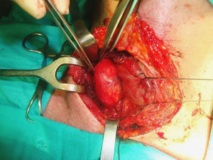 Imagen intraoperatoria: nódulo de 3×3cm lateral al lóbulo tiroideo derecho.