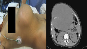 Vista lateral del tumor en el preoperatorio con correlación por TAC abdominal que confirma la localización del tumor sin invadir los órganos intraabdominales.