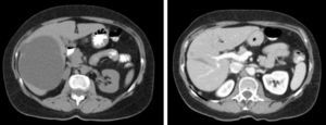 TAC abdominal: quiste simple prefenestración y posfenestración laparoscópica.