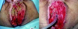 A: zona perineal tras la segunda intervención de desbridamiento antes de la colocación del sistema VAC. B: herida perineal tras el primer recambio del sistema VAC. Colocación de una sonda de silicona transanal.