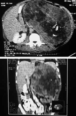Tomografía del oncocitoma adrenal.