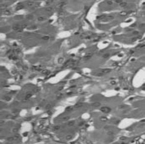 Células oncocíticas con citoplasma granular eosinófilico.